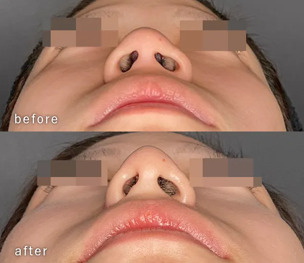 鼻整形の症例3