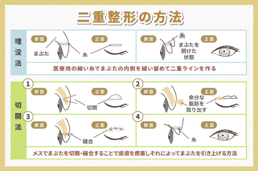 二重整形_方法