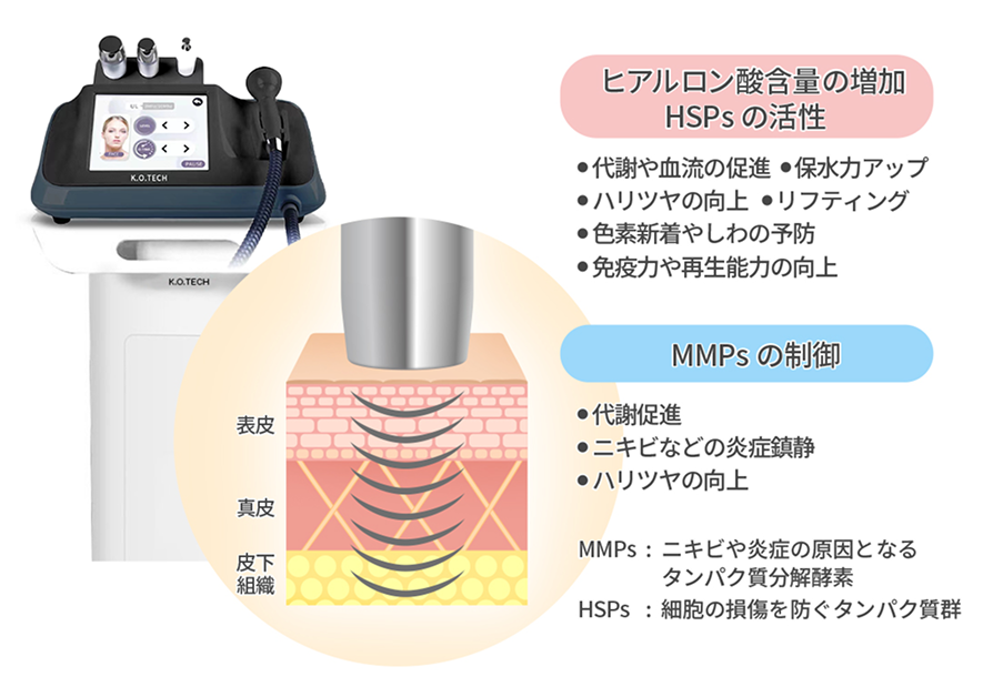 肌育注射・水光注射の併用治療のイメージ図。ヒアルロン酸含量の増加・HSPsの活性・MMPsの制御を肌の断面図で説明