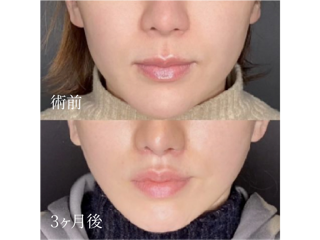 口元施術の症例写真。人中短縮術の術前と3ヶ月後の比較