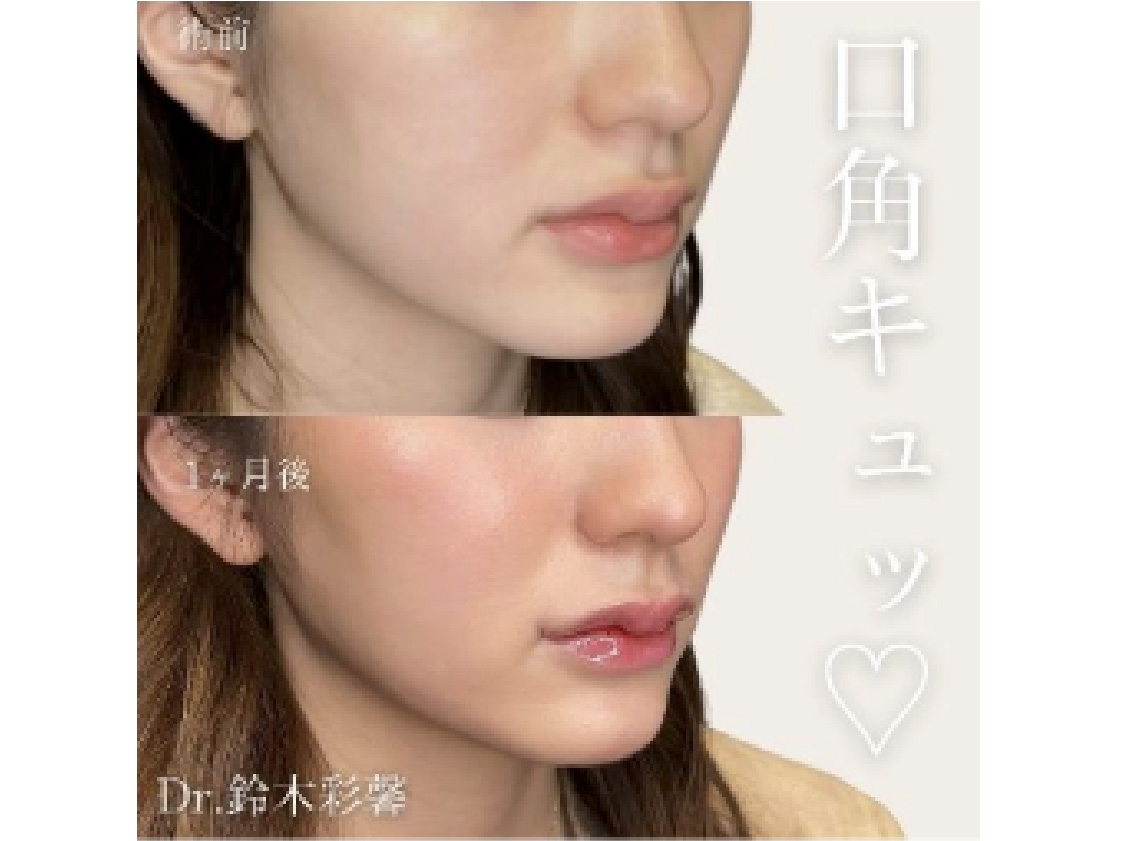 口元施術の症例写真。口角挙上術の術前と1ヶ月後の比較（Dr.鈴木彩馨）