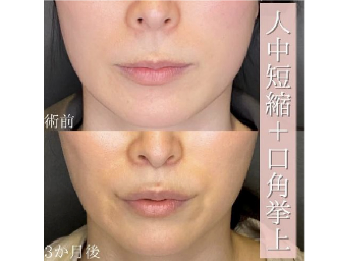 口元施術の症例写真。人中短縮＋口角挙上の術前と3ヶ月後の比較