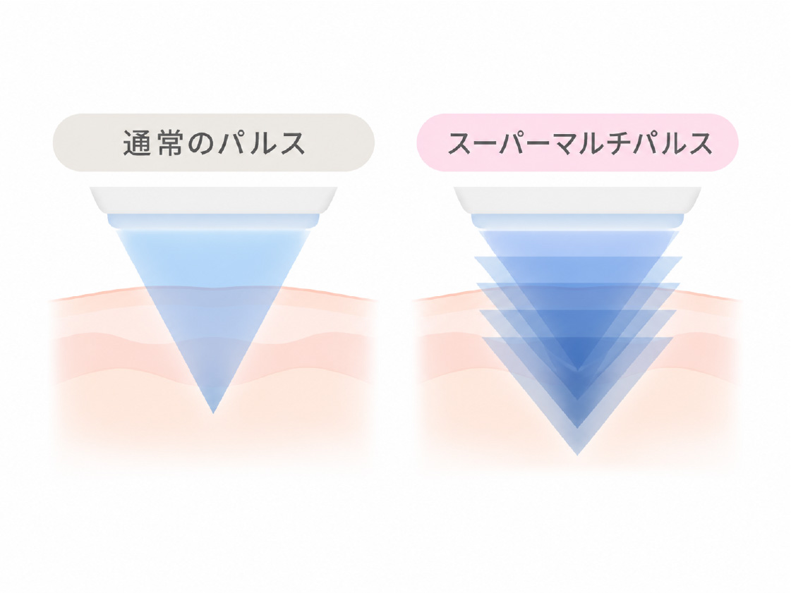 通常のパルスとスーパーマルチパルスの照射の深さの違いを示す図