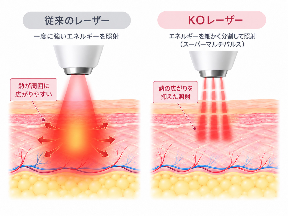 従来のレーザーとKOレーザーの比較図。従来は一度に強いエネルギーを照射して熱が周囲に広がりやすいが、KOレーザーはエネルギーを細かく分割して照射し熱の広がりを抑える