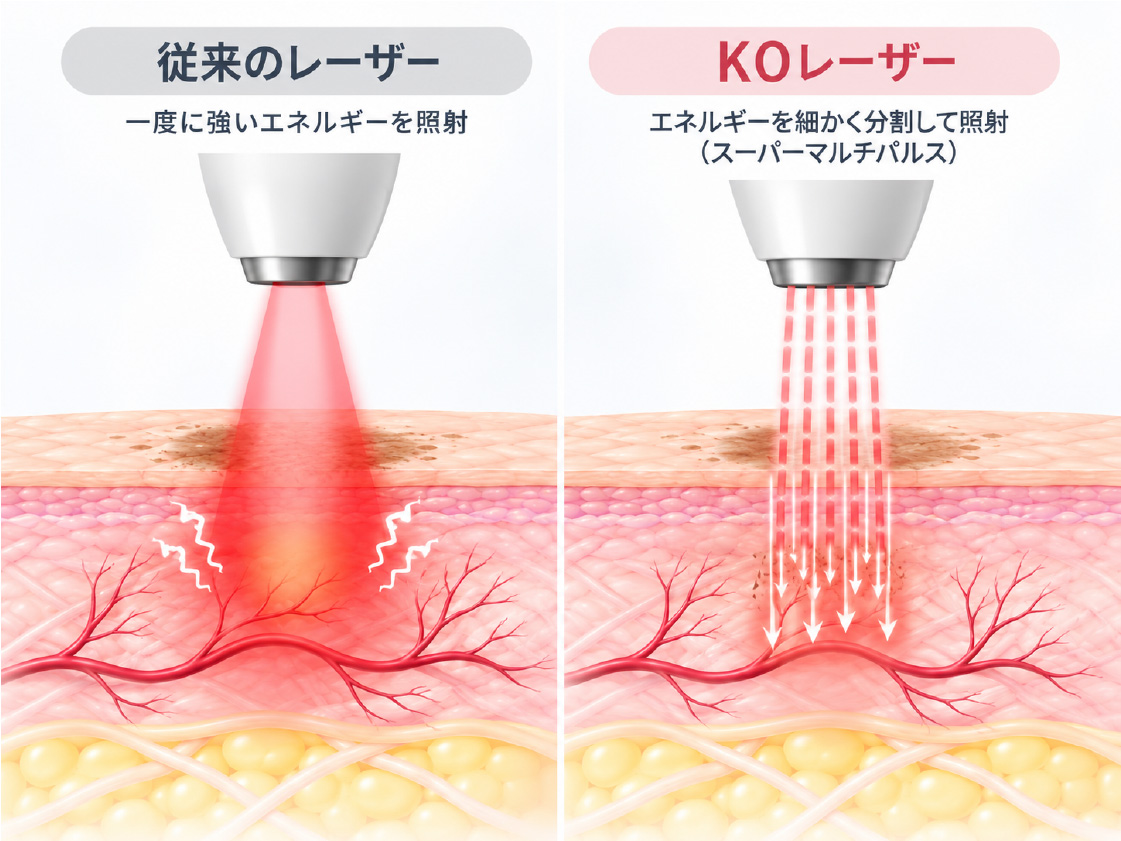 従来のレーザーとKOレーザーの比較図。KOレーザーはエネルギーを細かく分割して照射（スーパーマルチパルス）するため、ダメージを抑えながら肌の奥深くまで届く