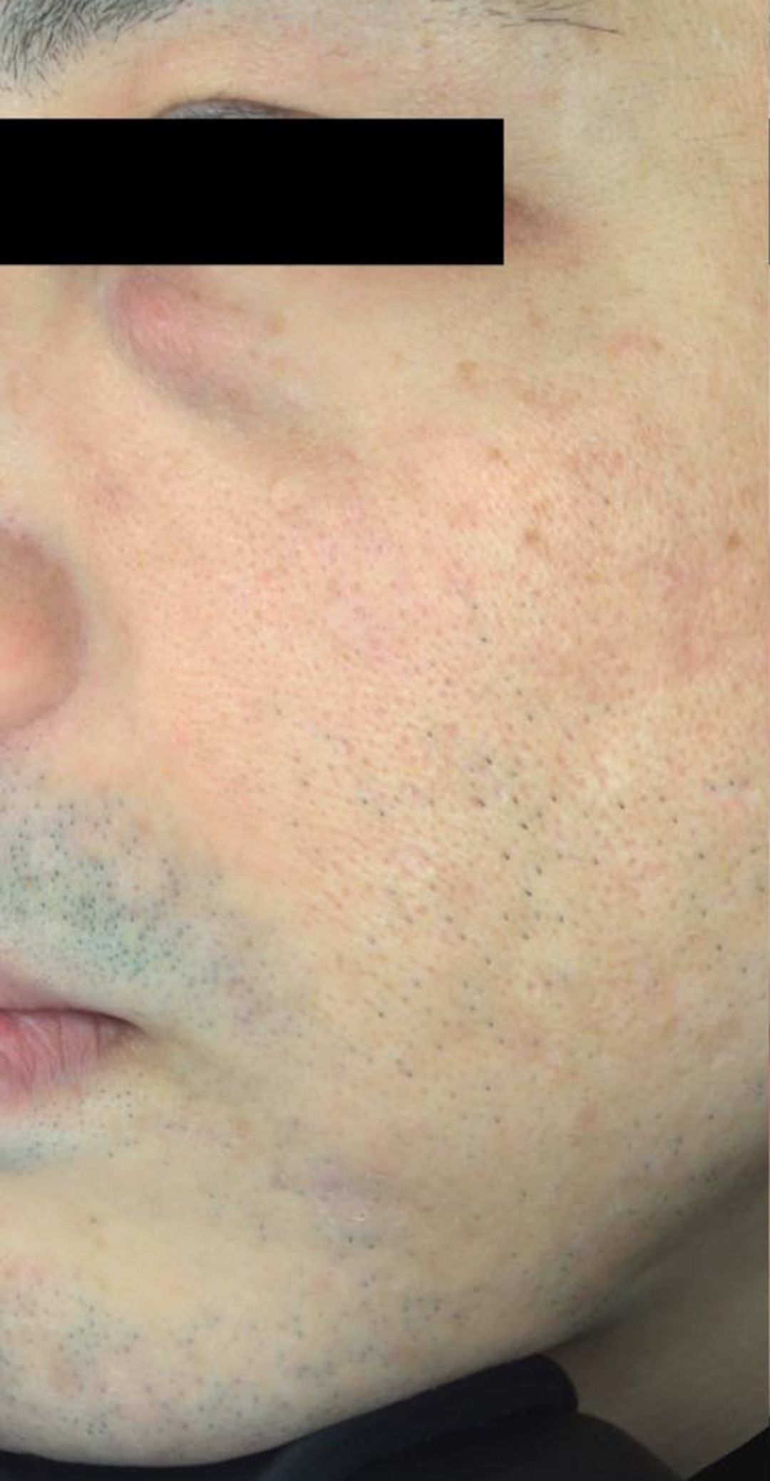 医療脱毛 before