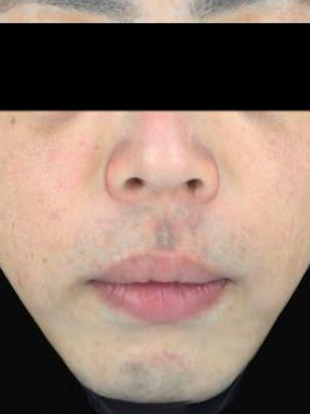 医療脱毛 after