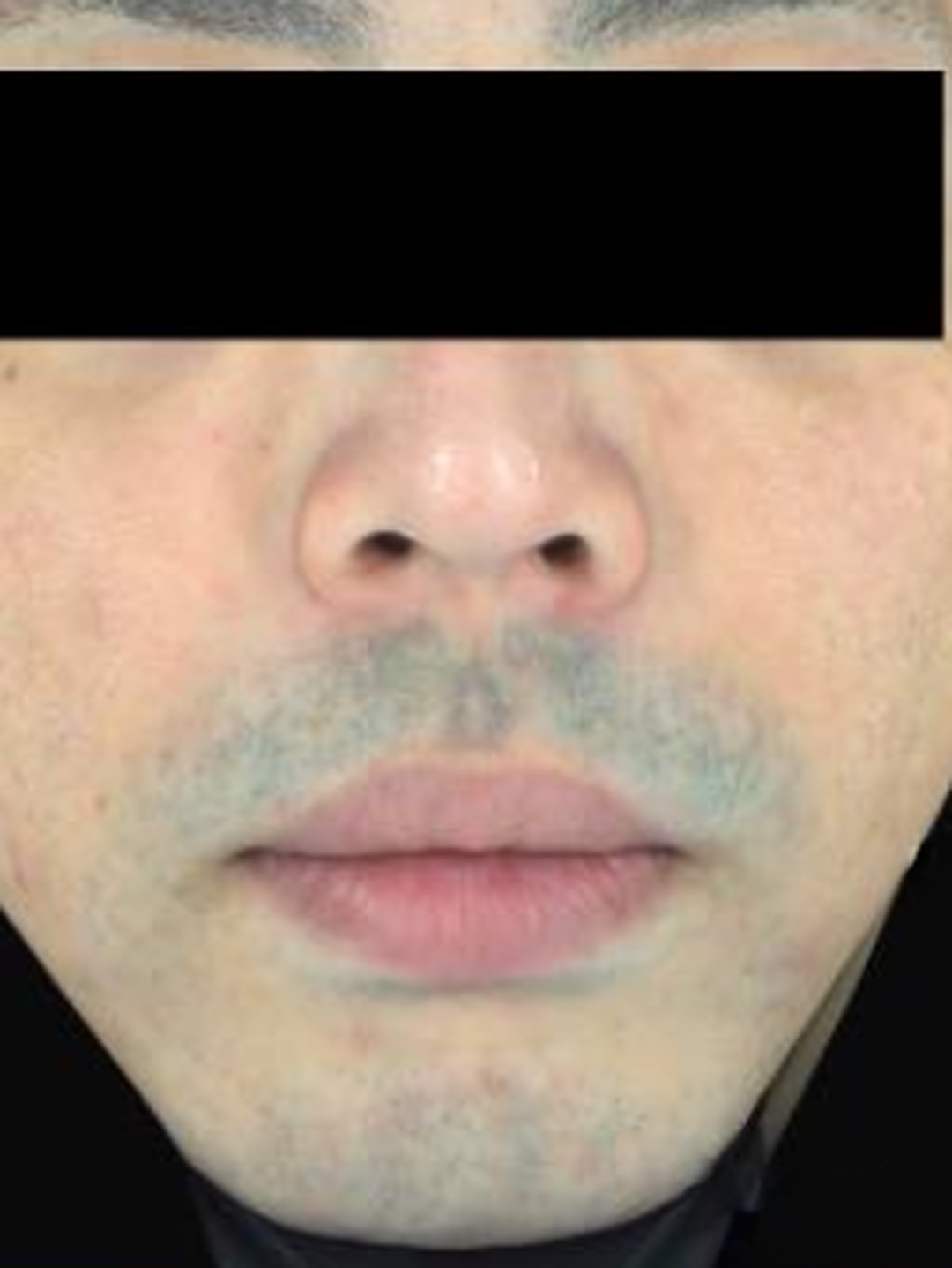 医療脱毛 before