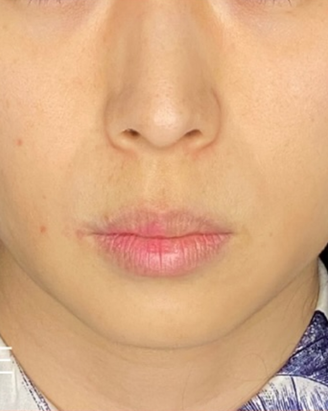 人中短縮術 before