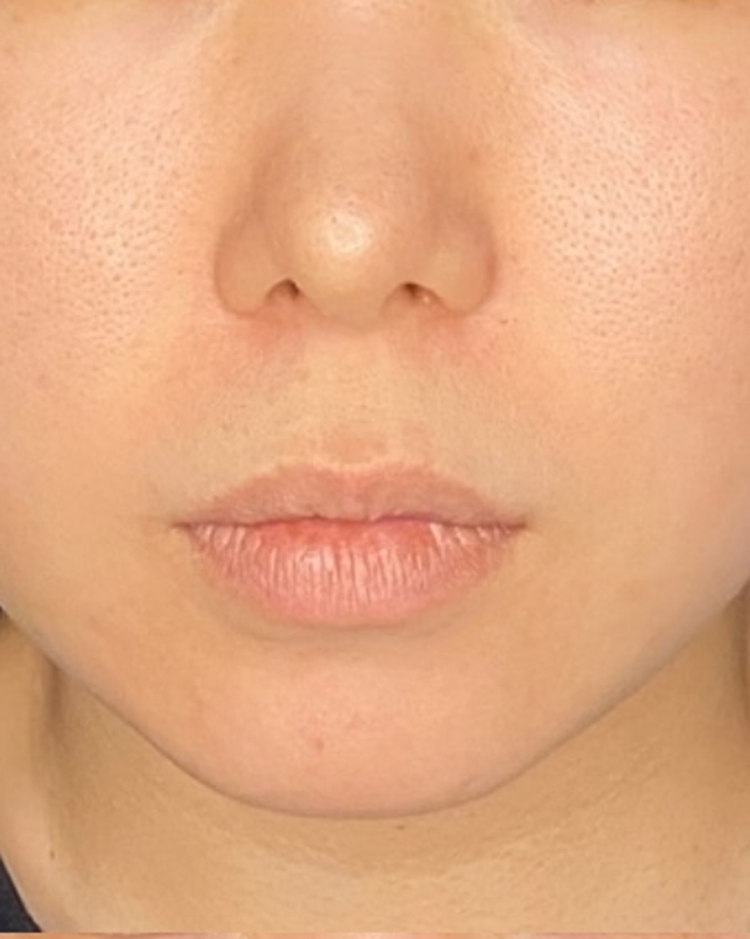 人中短縮術 before