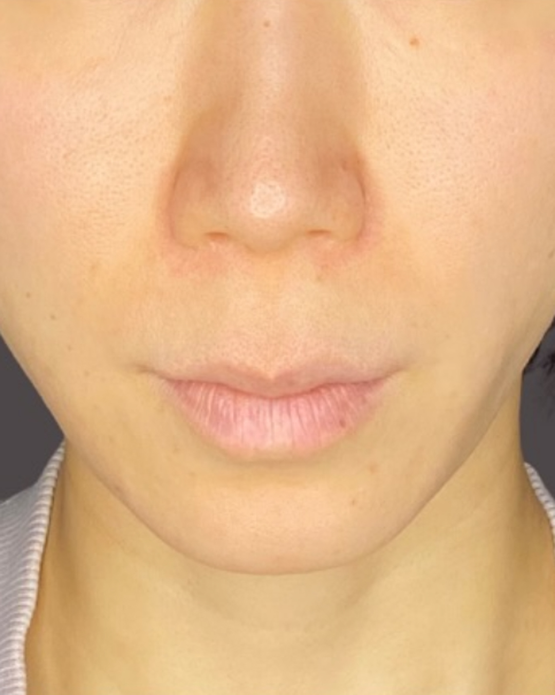 人中短縮術 before