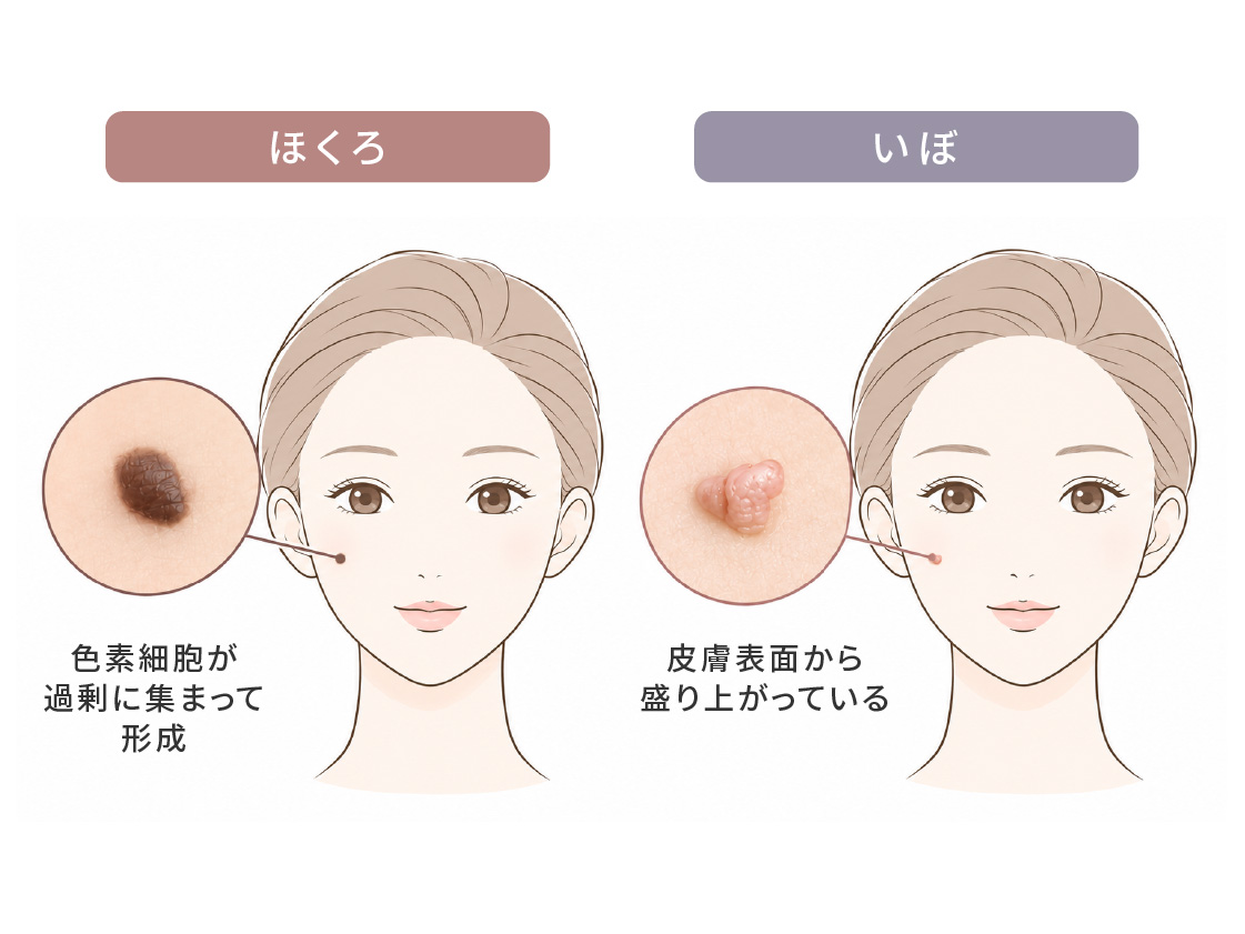 ほくろといぼの違いを示す顔のイラスト。ほくろは色素細胞が過剰に集まって形成され、いぼは皮膚表面から盛り上がっている