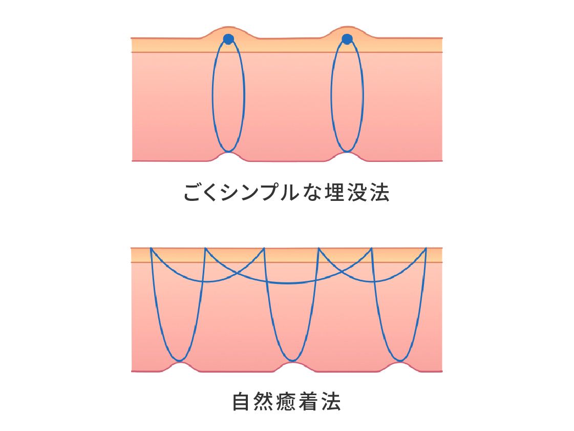 ごくシンプルな埋没法と自然癒着法の糸のかけ方の違いを示すまぶたの断面図