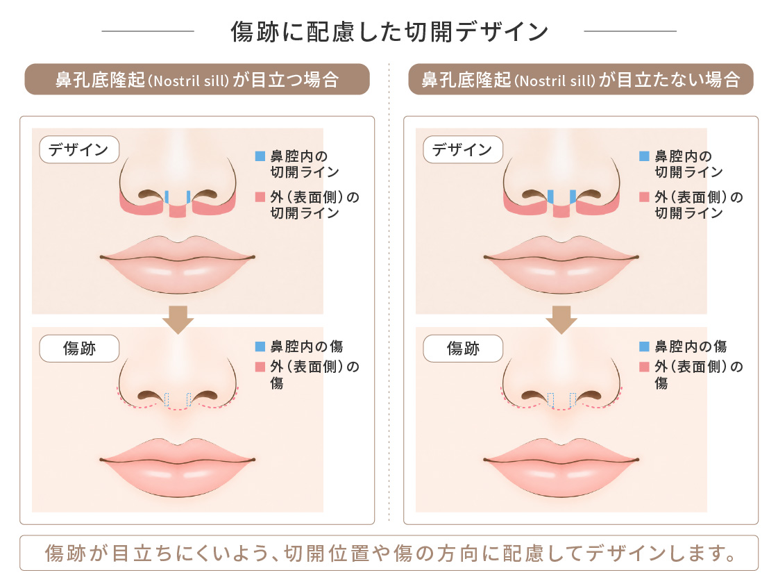 人中短縮術の傷跡に配慮した切開デザインの図。鼻孔底隆起が目立つ場合と目立たない場合で、鼻腔内・鼻翼側の切開ラインと傷跡の位置を示している