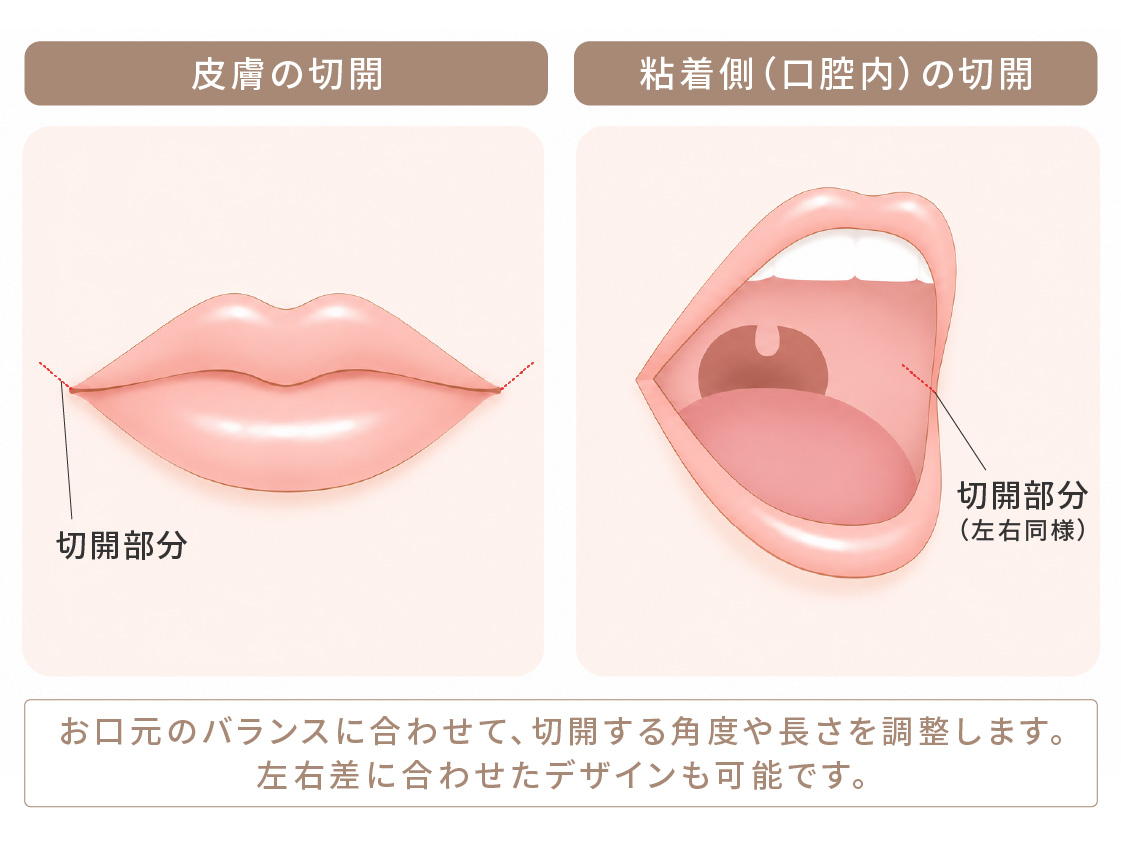口角挙上術の切開部分を示す図。皮膚の切開と粘膜側（口腔内）の切開。お口元のバランスに合わせて切開する角度や長さを調整し、左右差に合わせたデザインも可能