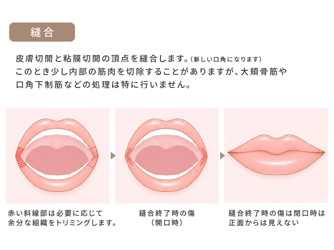 口角挙上術の縫合の図。皮膚切開と粘膜切開の頂点を縫合して新しい口角をつくる。縫合終了時の傷は閉口時は正面からは見えない