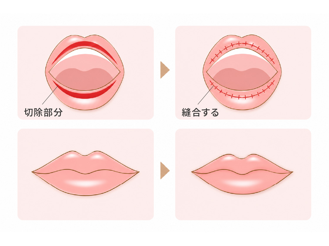 口唇縮小術の切除部分と縫合の図。唇の内側の粘膜を切除して縫合する