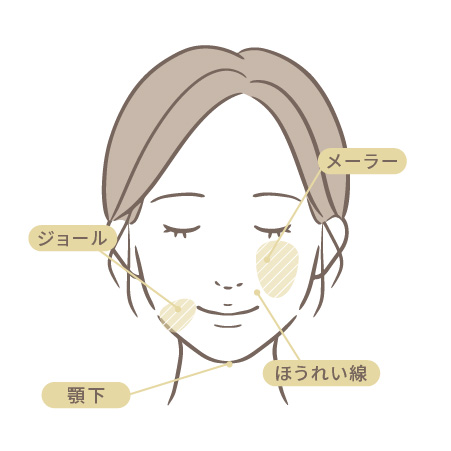 脂肪吸引（顔）の施術部位