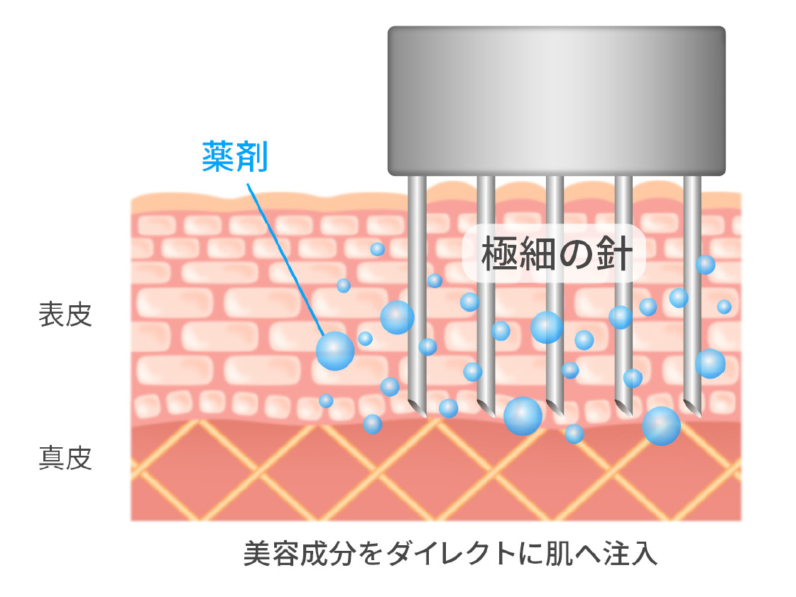 水光注射の仕組みを示す肌の断面図。極細の針で美容成分を表皮から真皮へダイレクトに注入