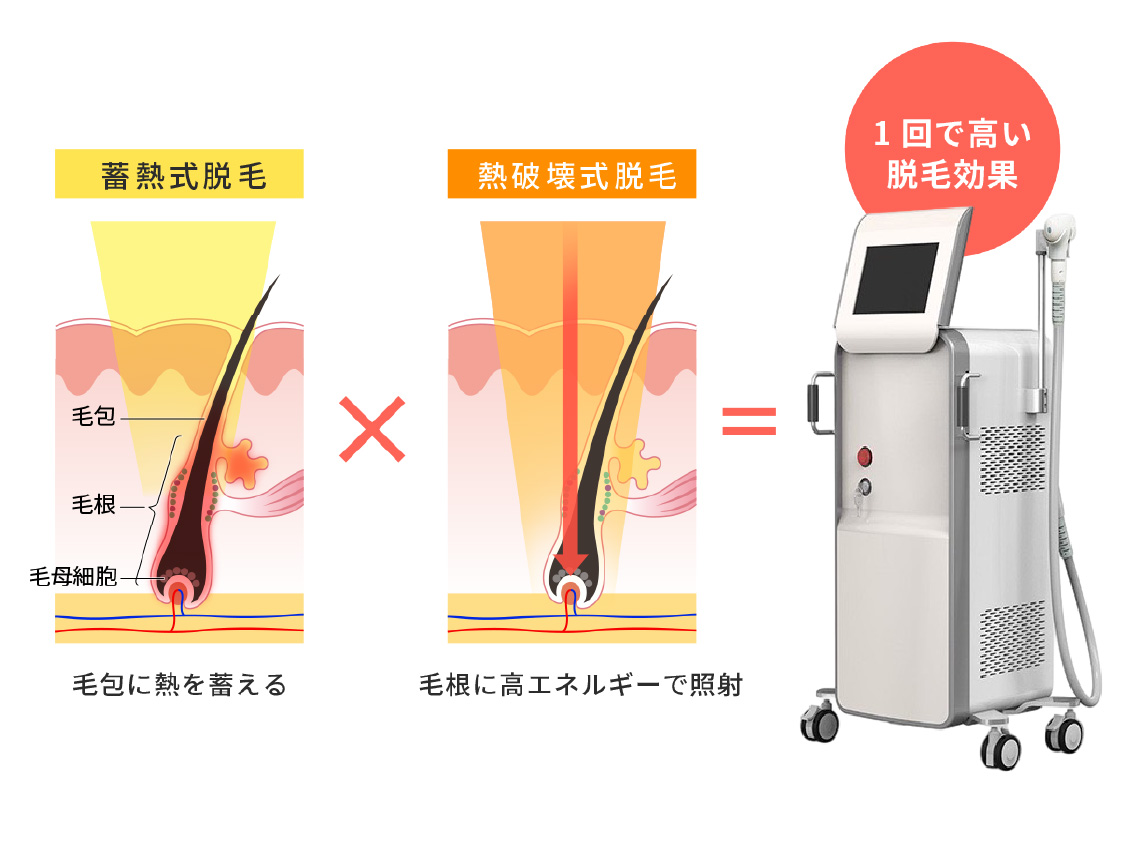 蓄熱式脱毛と熱破壊式脱毛の違いと、両方を組み合わせて1回で高い脱毛効果を出す仕組みを示す図。蓄熱式は毛包に熱を蓄え、熱破壊式は毛根に高エネルギーで照射